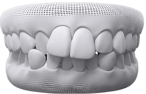 invisalign before after