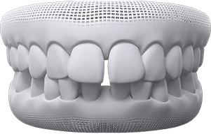 invisalign before after