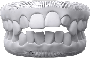 invisalign before after