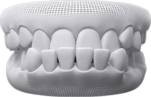invisalign before after