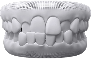 invisalign before after